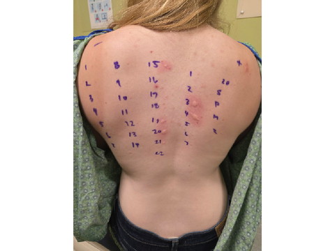 I got an allergy test!