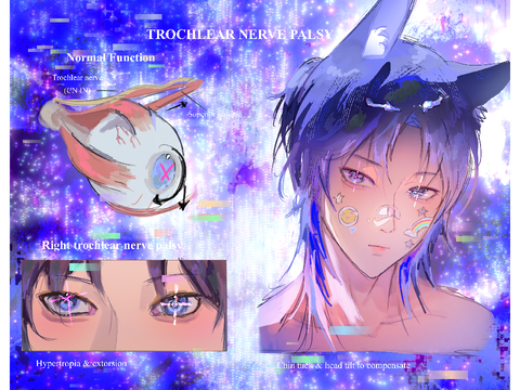 Trochlear Nerve Palsy art trend