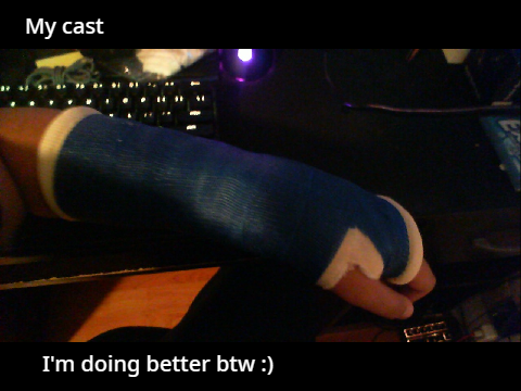 I broke my arm
