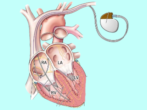 Pacemaker